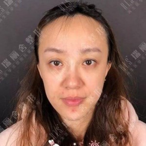 瑞麗舍整形馬君做的全臉自體脂肪填充，不錯呢~