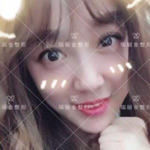 瑞麗舍整形馬君做的全臉自體脂肪填充，不錯呢~