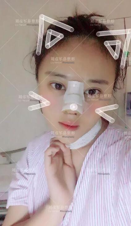 劉彥君隆鼻案例圖恢復(fù)記錄