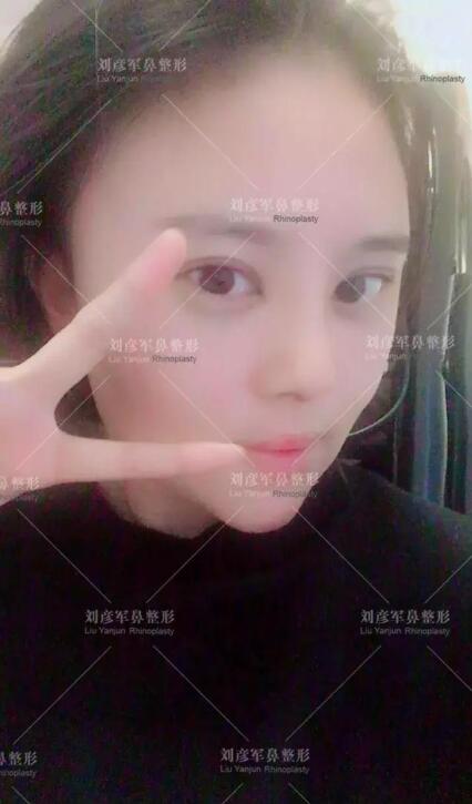 劉彥君隆鼻案例圖恢復(fù)記錄