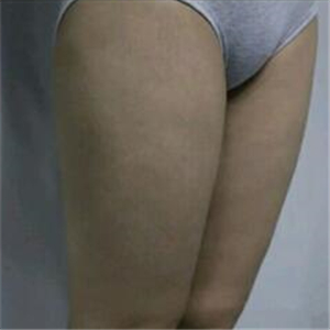 去找東方和諧馮斌做了大腿抽脂，分享一下果吧！