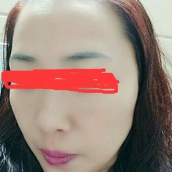 北京邦定張亞昆做的面部提升，果較為不錯(cuò)~