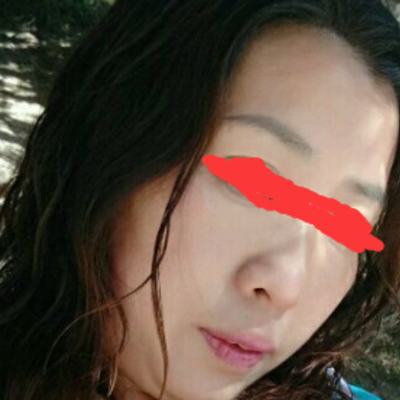 北京邦定張亞昆做的面部提升，果較為不錯(cuò)~