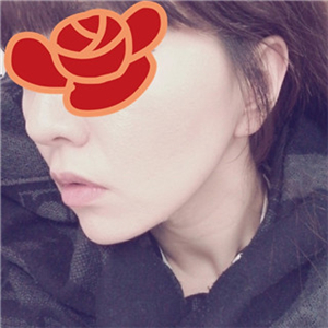 北京南加安棟顯給我做的自體脂肪去法令紋，果很好~