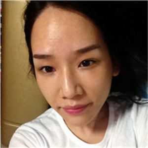 北京南加高紅霞醫(yī)生做的頭發(fā)種植，恢復(fù)得很好~