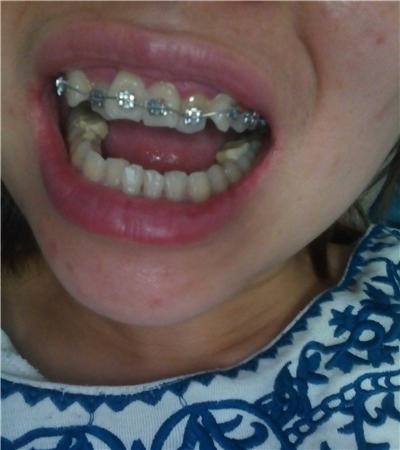 成都圣貝口腔翟永森做的牙齒矯正，分享果照片~