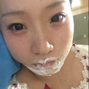 北京麗詩(shī)麗格楊明強(qiáng)玻尿酸豐唇半個(gè)月了，看看果~