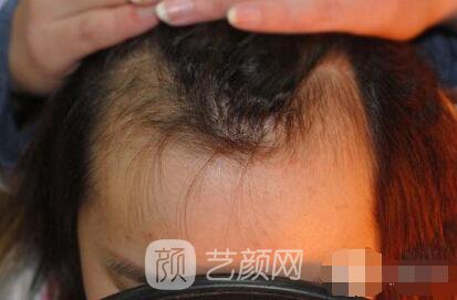 重慶西南醫(yī)院王量植發(fā)照片