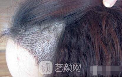 重慶西南醫(yī)院王量植發(fā)照片