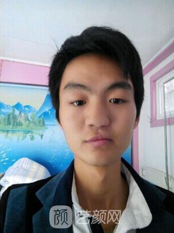 熊清華唇腭裂整形修復案例照片