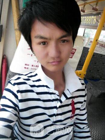 熊清華唇腭裂整形修復案例照片