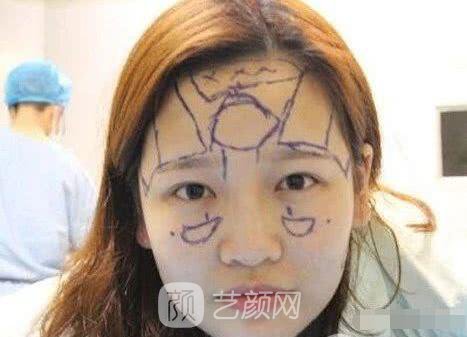 艾紅梅面部自體脂肪填充手術圖心情分享