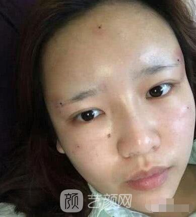 艾紅梅面部自體脂肪填充手術圖心情分享