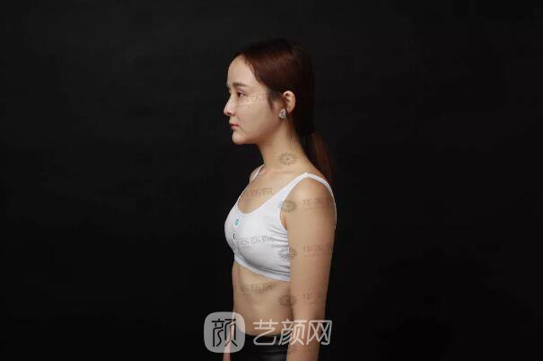 華美紫馨整形醫(yī)院謝凱英假體豐胸圖 真人案例分享哦~