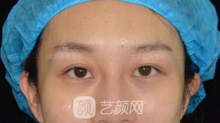 北京西美整形全切雙眼皮，徹底拯救我的大小眼
