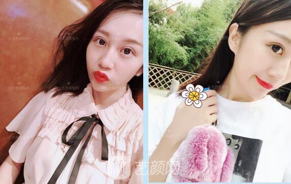 北京西美整形全切雙眼皮，徹底拯救我的大小眼