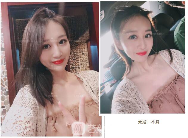 北京西美整形全切雙眼皮，徹底拯救我的大小眼