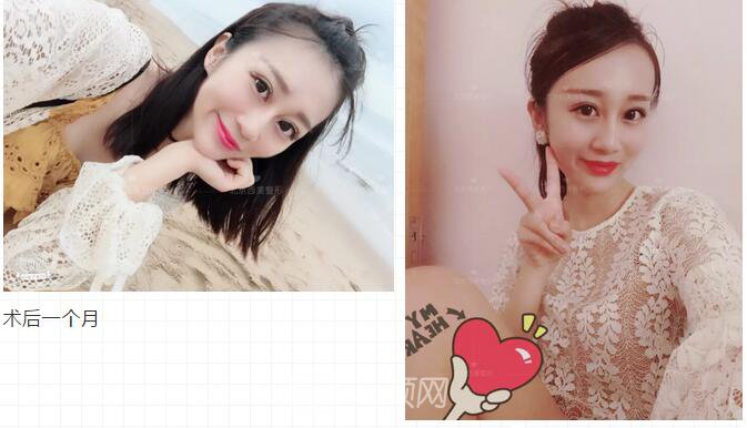 北京西美整形全切雙眼皮，徹底拯救我的大小眼