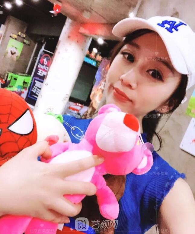北京西美整形全切雙眼皮，徹底拯救我的大小眼