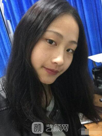 萍鄉(xiāng)優(yōu)美整形李清芳全切雙眼皮照片 拯救眼睛不對稱