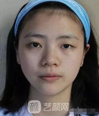 上海伊美爾港華醫(yī)院開雙眼皮圖 大小眼的救星