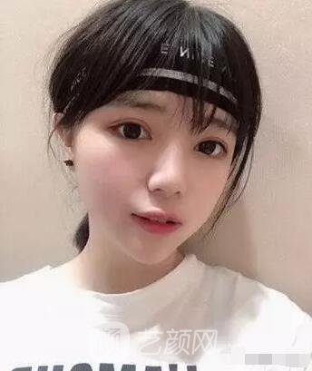 上海伊美爾港華醫(yī)院開雙眼皮圖 大小眼的救星