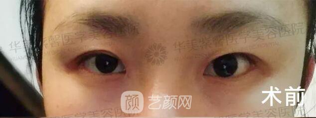 成都華美紫馨平行雙眼皮真人案例反饋照片
