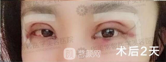 成都華美紫馨平行雙眼皮真人案例反饋照片