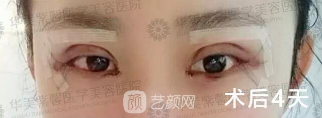 成都華美紫馨平行雙眼皮真人案例反饋照片