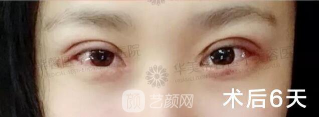 成都華美紫馨平行雙眼皮真人案例反饋照片
