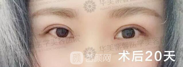 成都華美紫馨平行雙眼皮真人案例反饋照片