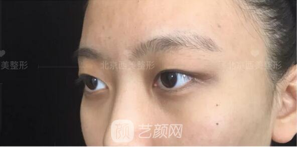 北京西美整形醫(yī)院全切雙眼皮真人案例圖|內(nèi)附恢復(fù)過程哦~