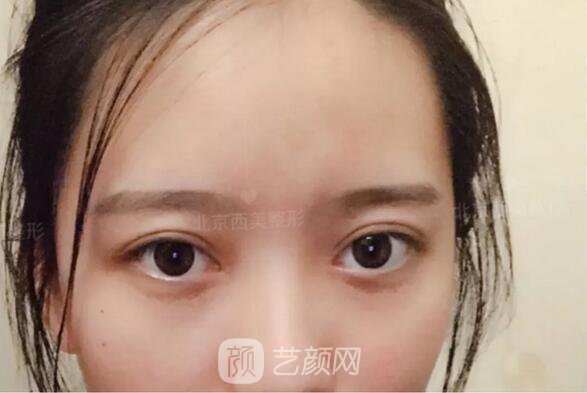 北京西美整形醫(yī)院全切雙眼皮真人案例圖|內(nèi)附恢復(fù)過程哦~