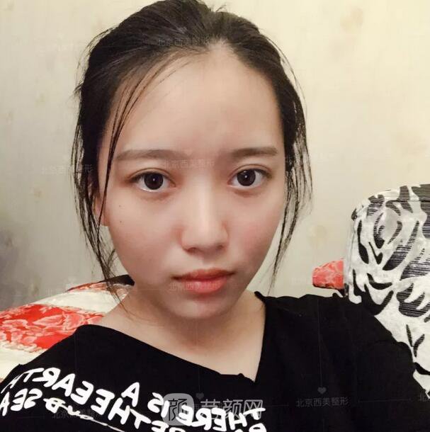 北京西美整形醫(yī)院全切雙眼皮真人案例圖|內(nèi)附恢復(fù)過程哦~