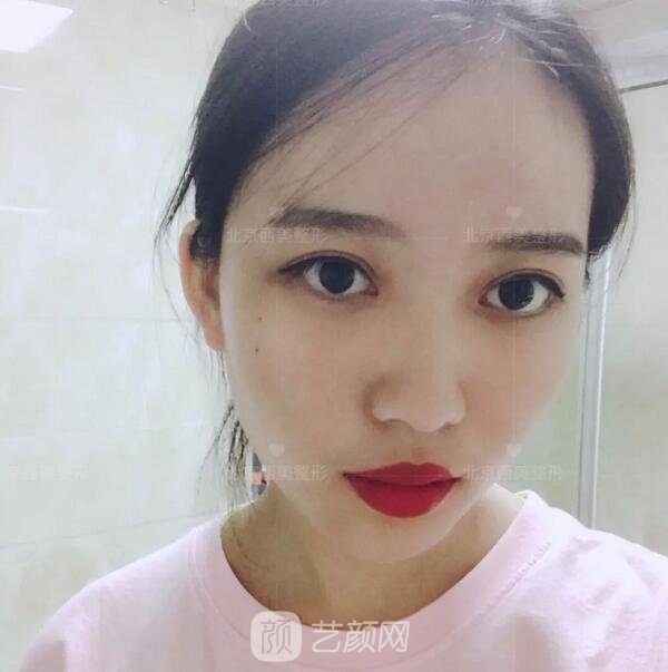 北京西美整形醫(yī)院全切雙眼皮真人案例圖|內(nèi)附恢復(fù)過程哦~