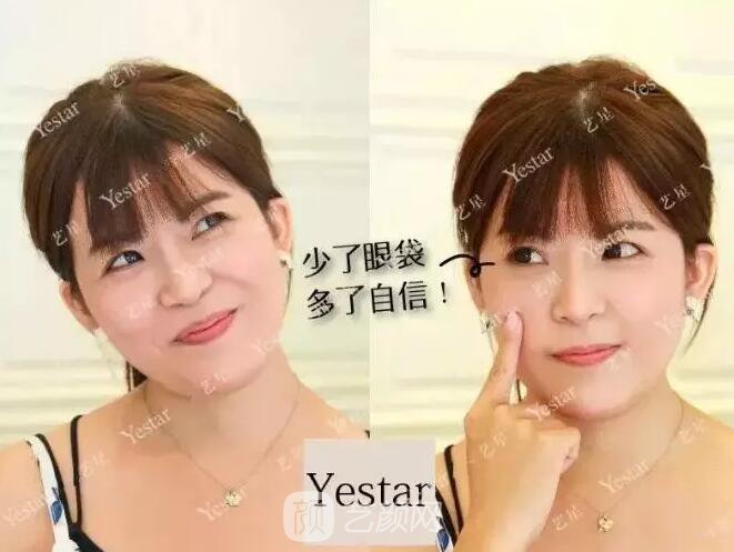 北京藝星整形Yestar分齡祛眼袋真實案例圖分享哦~