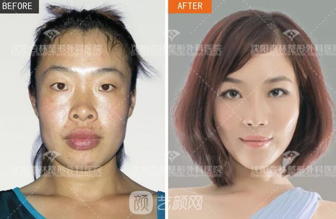 沈陽杏林朱石江三維顴骨縮小術(shù)真人案例圖分享