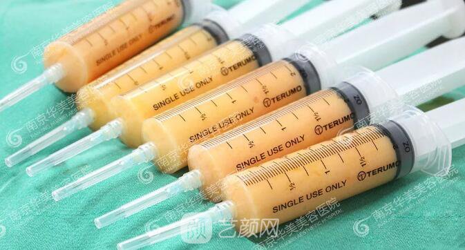 南京華美裴旭芳怎么樣?自體脂肪填充全臉真人案例