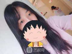 成都嬌點(diǎn)姜宇祿雙眼皮修復(fù)案例，重獲新生！