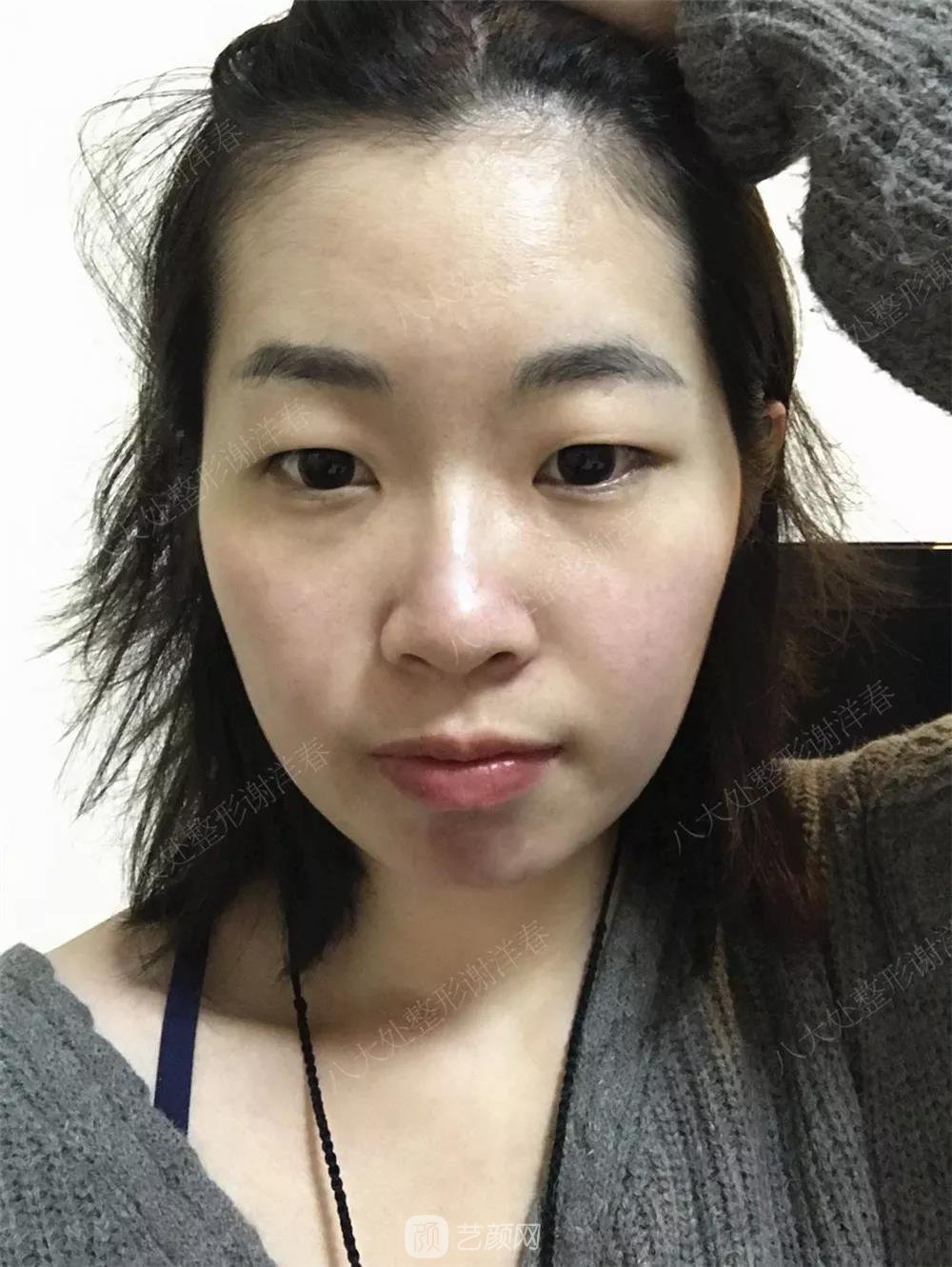 北京八大處割雙眼皮恢復(fù)過程，內(nèi)附圖