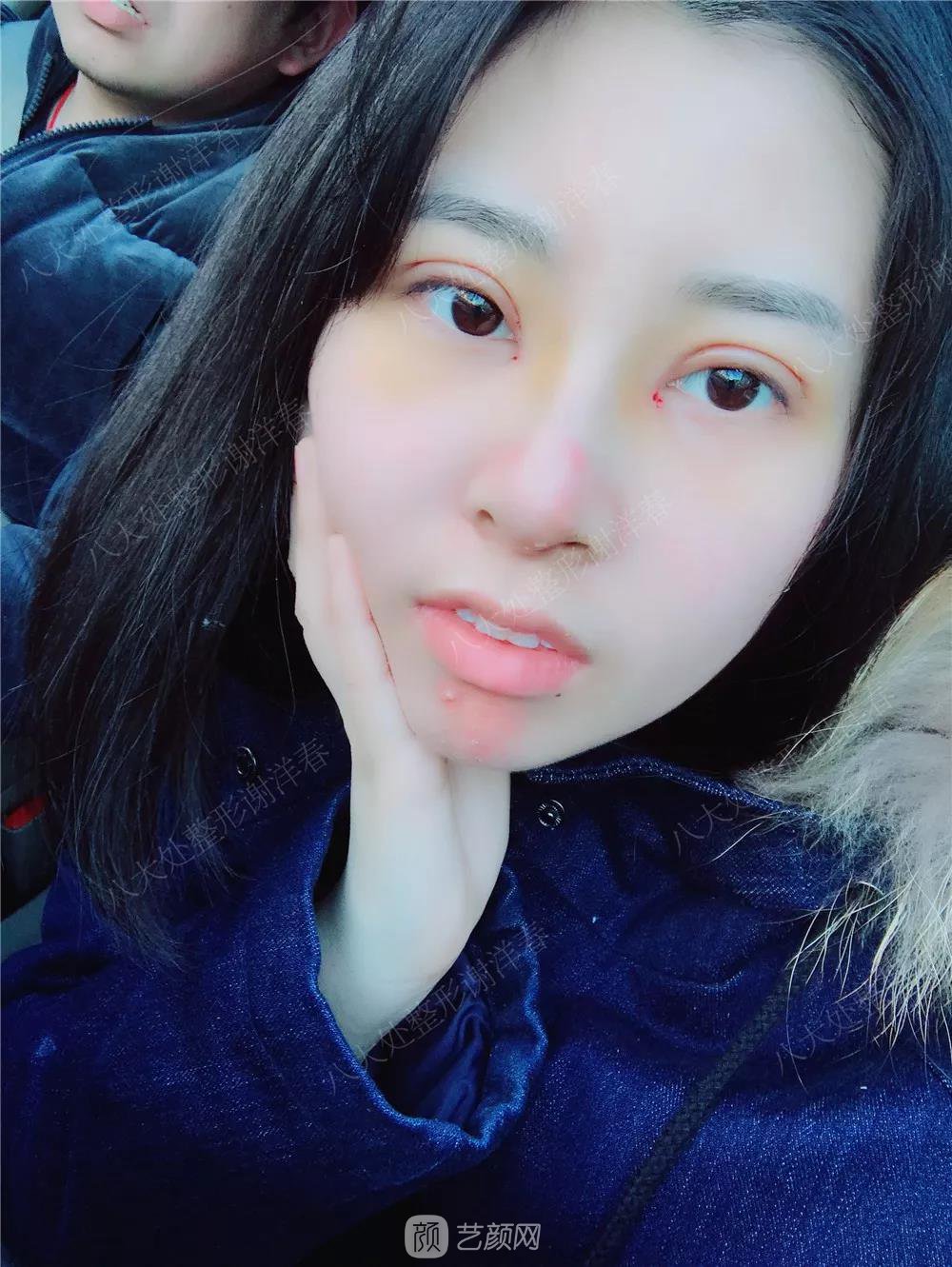 北京八大處割雙眼皮恢復(fù)過程，內(nèi)附圖