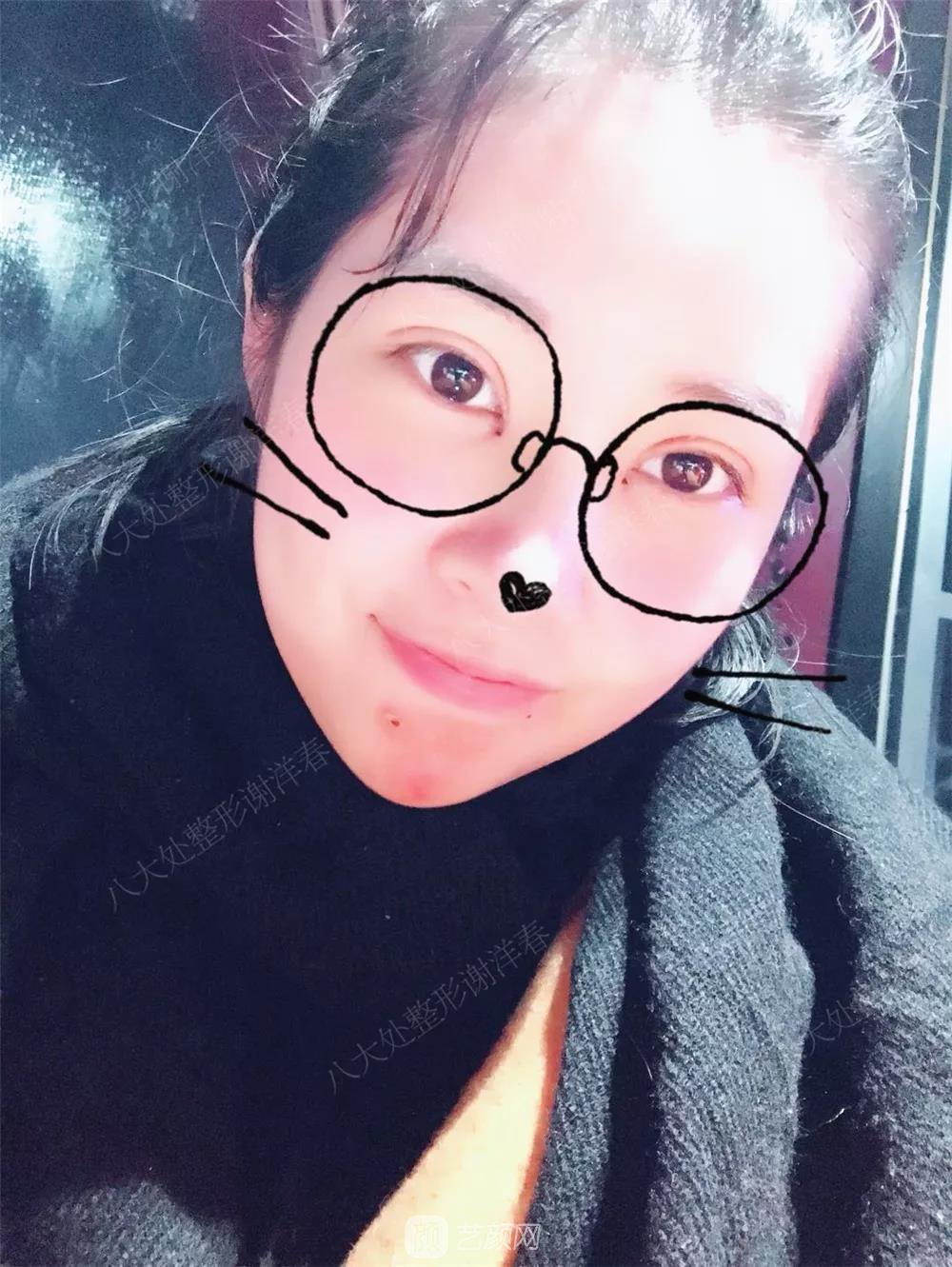 北京八大處割雙眼皮恢復(fù)過程，內(nèi)附圖