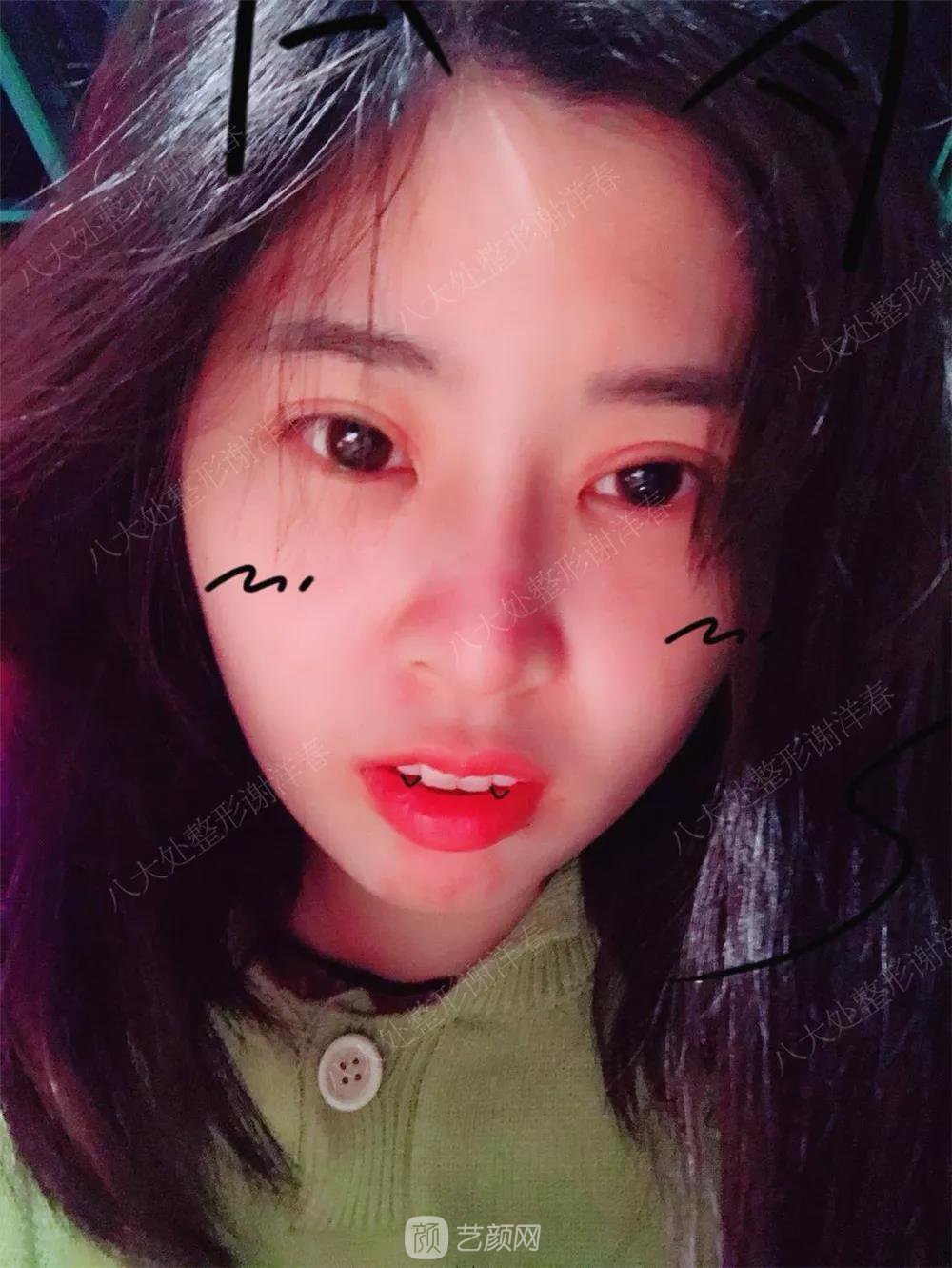 北京八大處割雙眼皮恢復(fù)過程，內(nèi)附圖