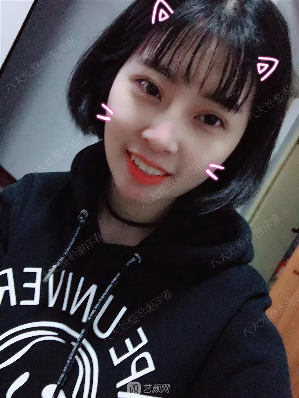 北京八大處割雙眼皮恢復(fù)過程，內(nèi)附圖