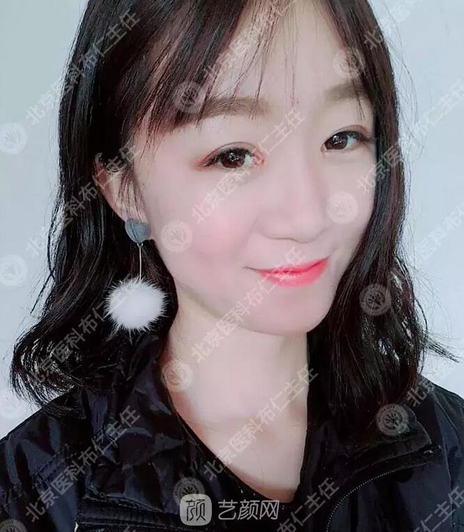 北京八大處整形布仁全切雙眼皮真實案例|圖