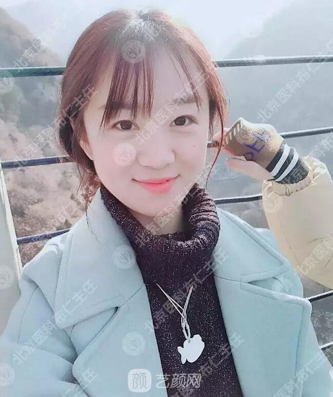 北京八大處整形布仁全切雙眼皮真實案例|圖