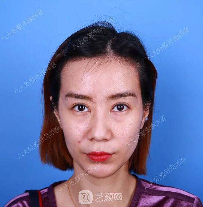 北京八大處面部脂肪填充心形臉真實(shí)案例|照片