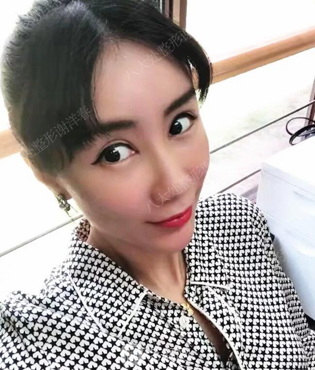 北京八大處面部脂肪填充心形臉真實(shí)案例|照片
