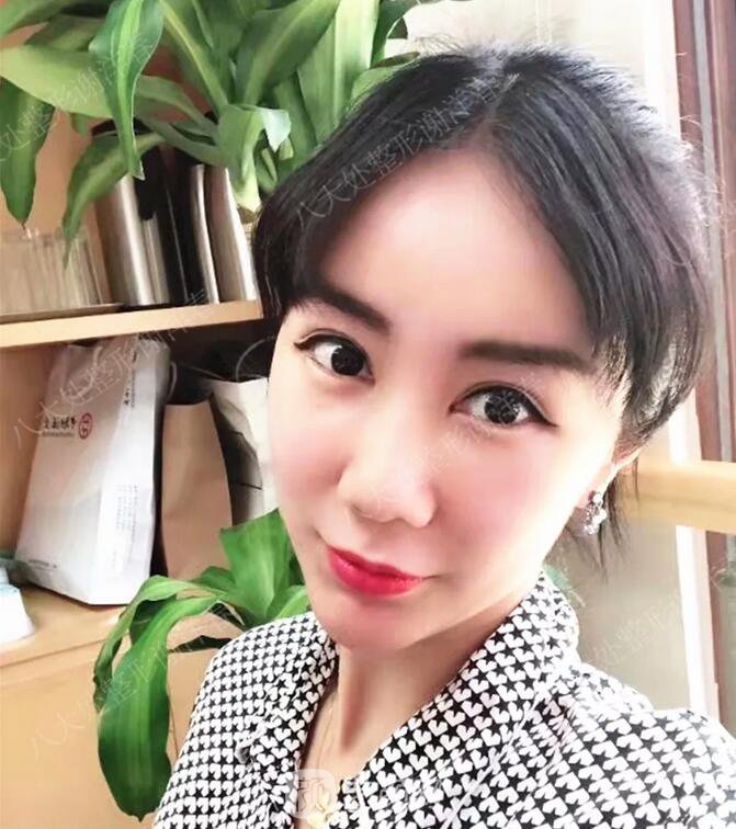 北京八大處面部脂肪填充心形臉真實(shí)案例|照片