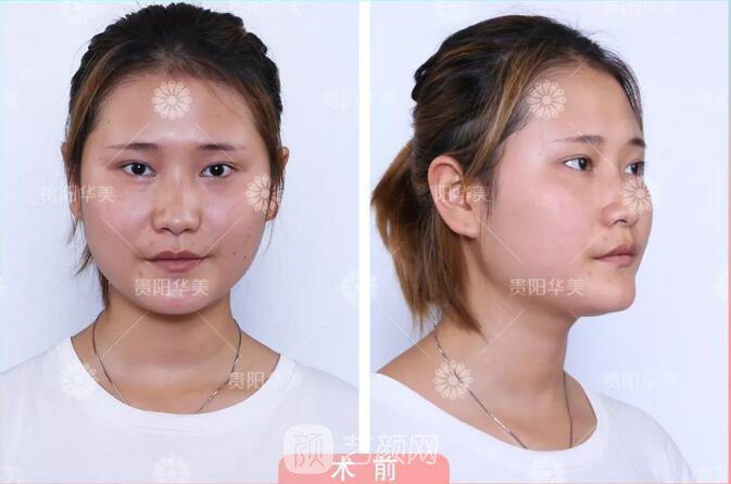 貴陽(yáng)華美謝占軍割雙眼皮+隆鼻真人案例圖分享